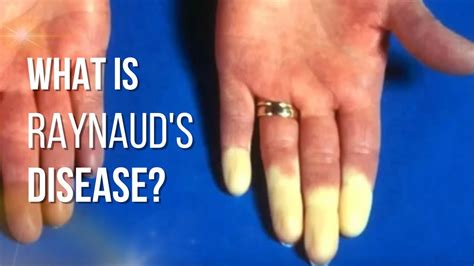What Is Raynauds Disease Raynauds Syndrome All The Facts Youtube