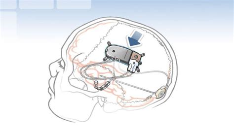 Using Brain Computer Interfaces As A Solution For Epilepsy By Maahum Ali Medium