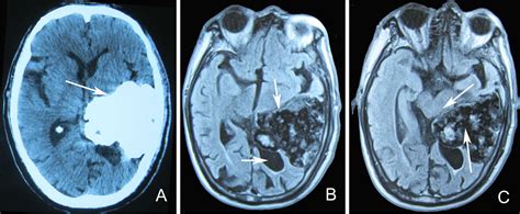 Rare Huge Congenital Intracranial Silent Teratoma In Older People A