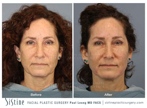 Jawline Slimming Before And After 06 Sistine Facial Plastic Surgery
