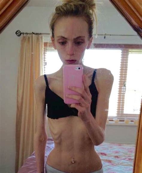 Anorexic Girls
