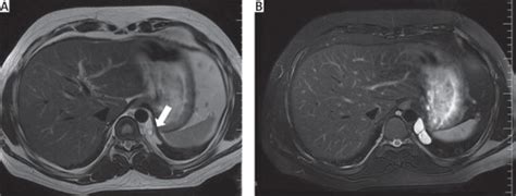 Posterior Mediastinal Paraganglioma Presenting With Hypertension And