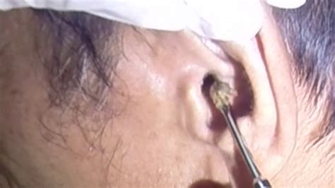 Rock Hard Earwax Removal Youtube