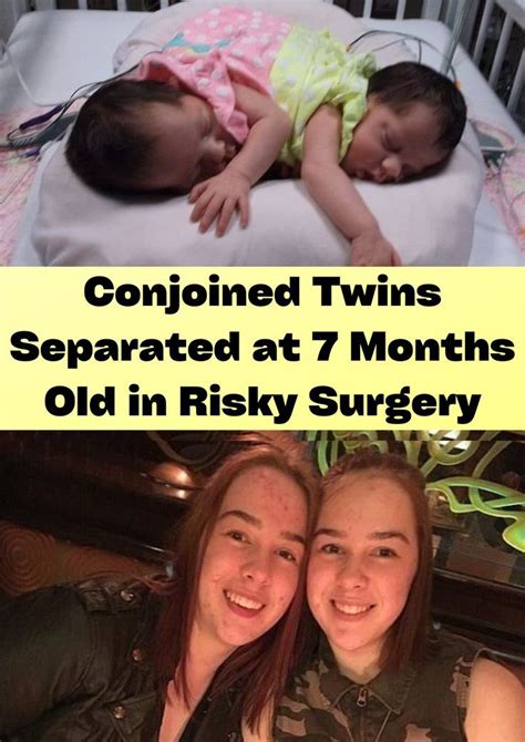 conjoined twins separated at 7 months old in risky surgery conjoined twins 7 month olds 7