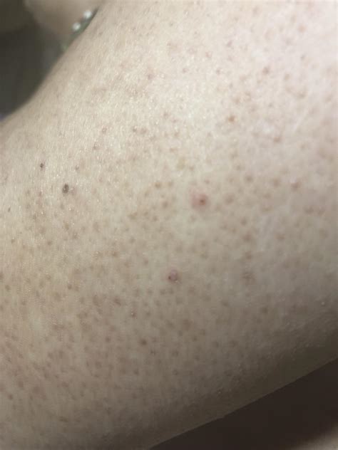 Any Idea What These Bumps On My Bfs Arms Are He Calls Them Blackheads