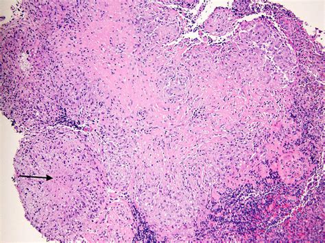 Necrotizing Granulomatous Inflammation Involving Lymph Node Tissue