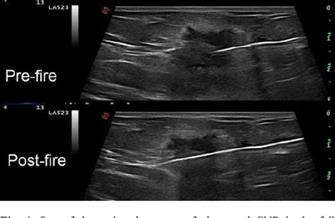 Ultrasound Guided Core Needle Biopsy Of Breast Lesions Insights Into