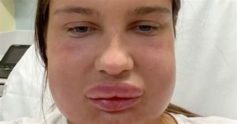 Womans Lips Ballooned After Getting Filler Dissolved Due To Nasty Reaction Daily Star