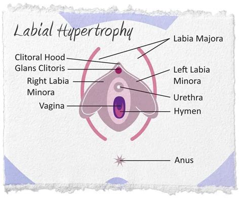 Labial Hypertrophy Northeast Ohio Urogynecology Urogynecology And Pelvic Reconstructive
