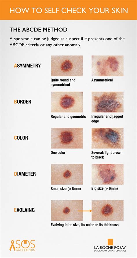 Abcde Melanoma Test Hand Out