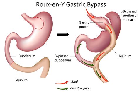 Gastric Bypass Roux En Y General Surgery Gold Coast
