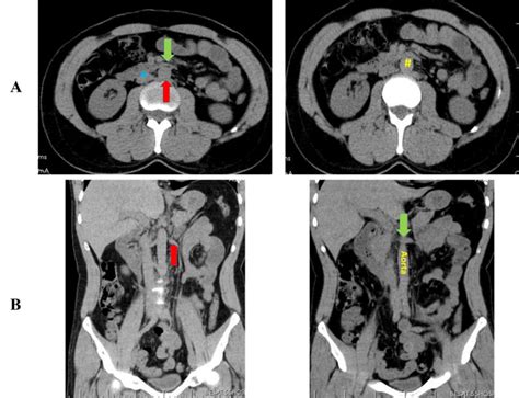 Ct Scan Images Without The Contrast Of The Abdominal Region A Axial