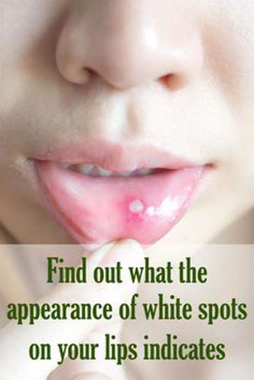 7 Best Tips To Treat White Spots On Lips Medicine Health Life