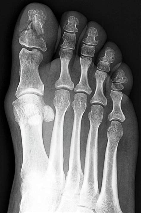 Broken Toe Bone Photograph By Zephyrscience Photo Library Fine Art
