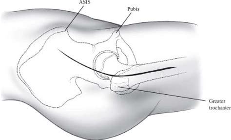 Watson Jones Approach Musculoskeletal Key