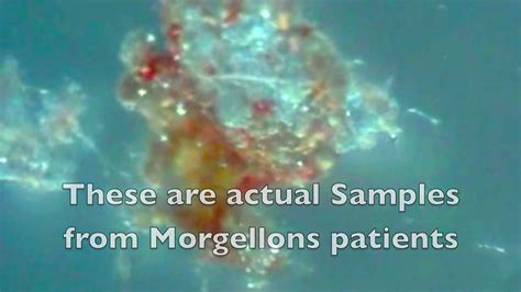 Morgellons Real Or Delusion Under The Microscope Youtube