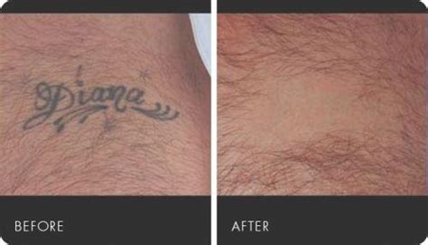 They are typically applied by a tattoo artist or a. The Laserless Tattoo Removal Guide Review: See My Results!