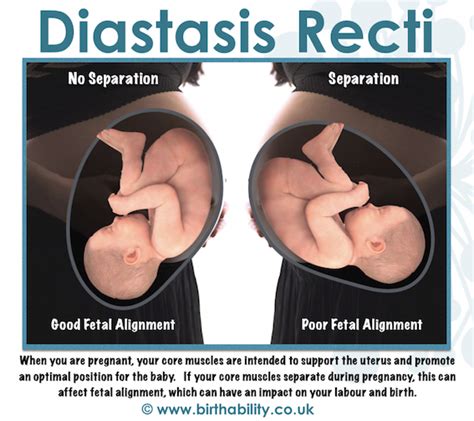 What Is Diastasis Recti And How Can I Fix It My Nice Blog 5632