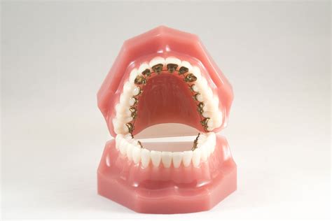 How Lingual Braces Work Brilliant Smiles Orthodontics