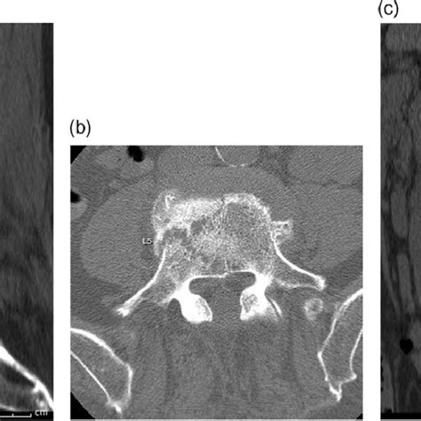 Median Parasagittal And Axial Images From A Lumbar Ct Scan Obtained