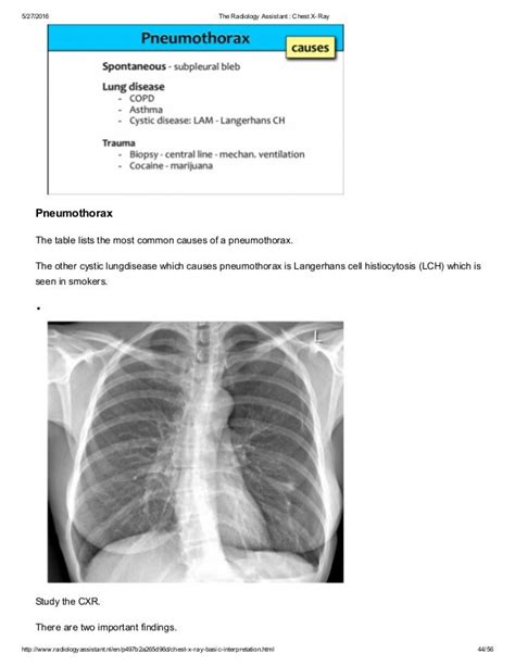 The Radiology Assistant Chest X Ray Basic Interpretation