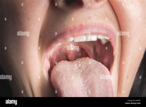 Tongue Disease Hi Res Stock Photography And Images Page Alamy Erofound