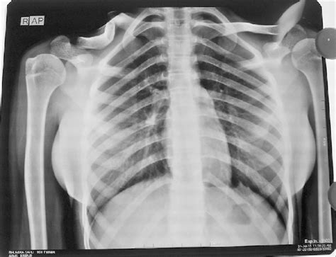 X Ray Chest P A View Showing Congenital Pseudarthrosis Of The Clavicle