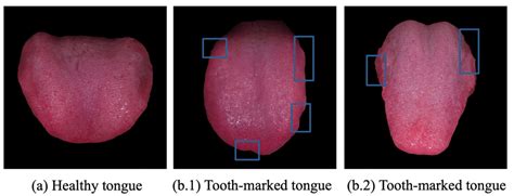 Examples Of A Heathy Tongue And Tooth Marked Tongues The Tooth Marked