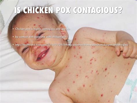 Chickenpox By Michael Johnson