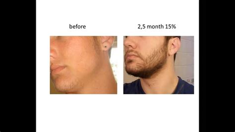 With minoxidil, it's all about patience and commitment! Stimulate Beard Growth with Minoxidil Before & After - YouTube