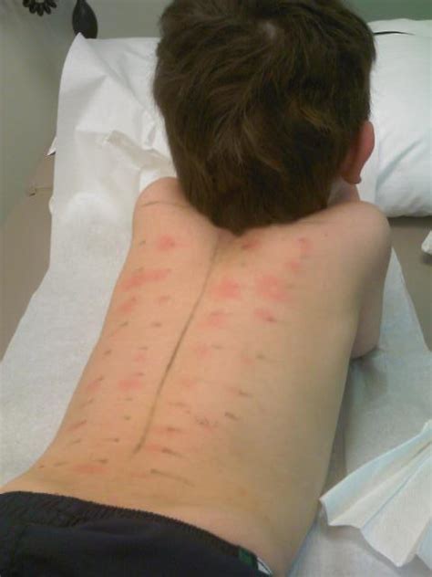 How to test for food allergies? allergy prick test - pictures, photos