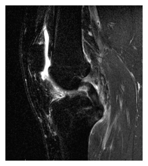 T2 Weighted Fat Suppressed Sagittal Plane Mri Images For Evaluation Of