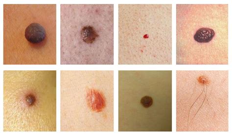 types of moles skin tags skin moles causes treatment my xxx hot girl