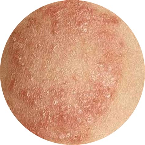 Ringworm Rashes Causes And Treatments Remotederm
