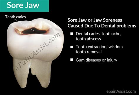 Sore Jaw Or Jaw Sorenesstreatmentcausessymptoms