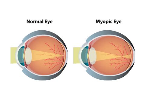 Myopia Chinese Chelvin Sng Eye Center Glaucoma Cataract