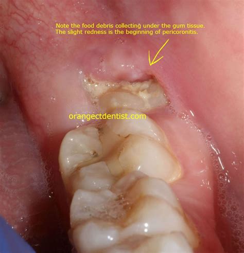 How Long Does It Take To Heal From Wisdom Teeth Removal Boston