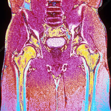 Coloured Mri Scan Of Section Through A Mans Hips Stock Image P116