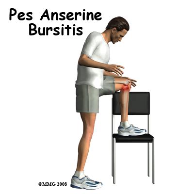 Physical Therapy In Harlem For Knee Pes Anserine Bursitis