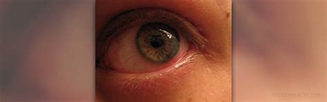 Types Of Eye Infections In Adults Eye Disorders And Diseases Articles