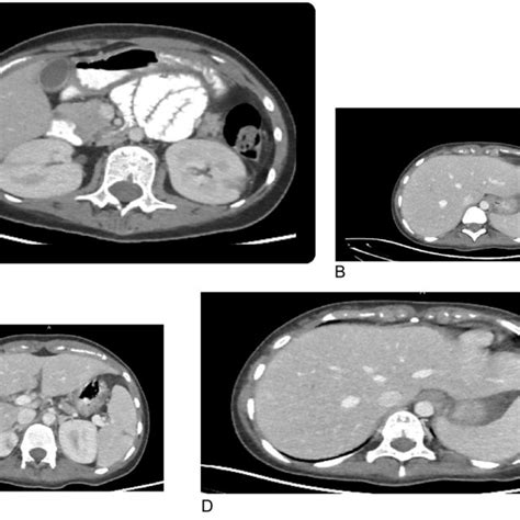 A Axial Ct Scan With Iv And Oral Contrast Portal Venous Phase Shows