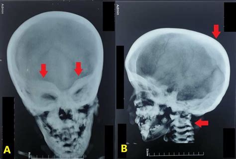 Skull Radiographs Show A Periorbital Sclerosis Arrows And B