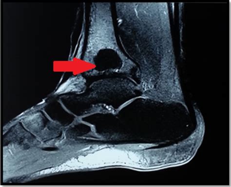 Intraosseous Ganglion Cyst Of The Distal Tibia A Rare Entity In A