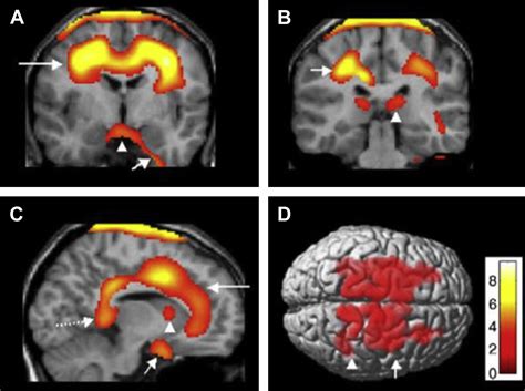 Neuroimaging Of Narcolepsy And Kleine Levin Syndrome Sleep Medicine