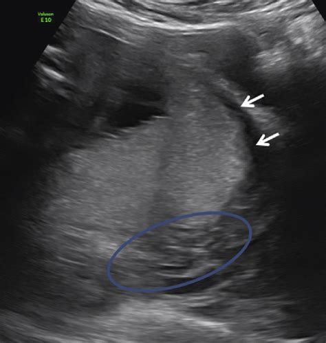 E Transabdominal Ultrasound Image Of The Placenta This Image