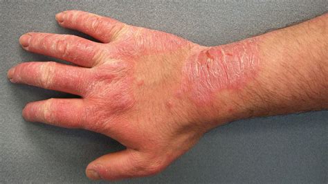 Contact Dermatitis Rash On Hands Amazing Design Ideas