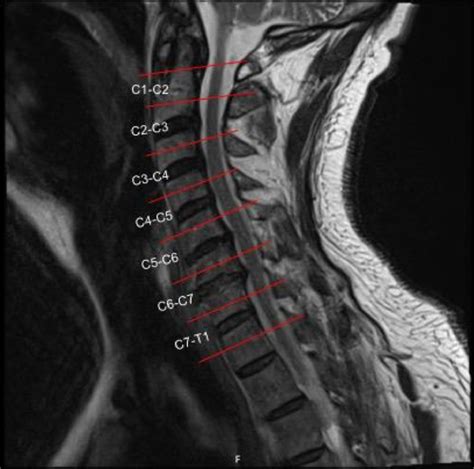 Impact Of Cervical Stenosis On Multiple Sclerosis Lesion Distribution