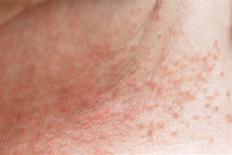 How To Get Rid Of Heat Rash Prickly Heat Riverchase Dermatology