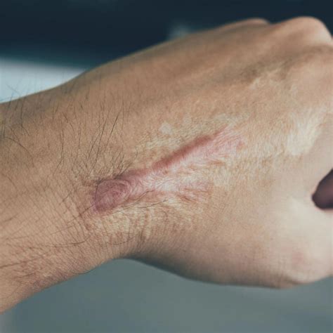 Traumatic Scars Brisbane Skin Dermatologist Brisbane Medical