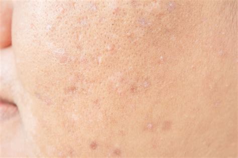Premium Photo Scar From Acne On Face And Skin Problems And Pores In